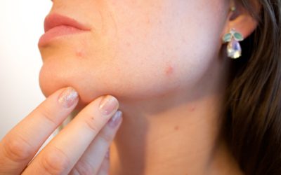 Lutter contre les cicatrices de boutons