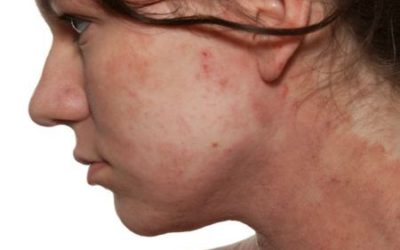 Les meilleurs aliments qui soulagent Eczéma