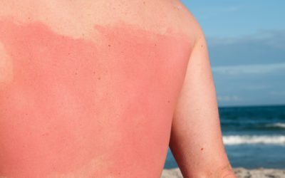 7 remèdes naturels contre les coups de soleil
