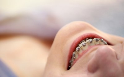 L’orthodontie pour l’enfant : quand faut-il consulter ?