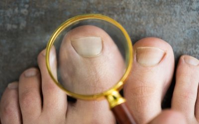 Traitements naturels pour soulager un ongle incarné et prévenir les infections