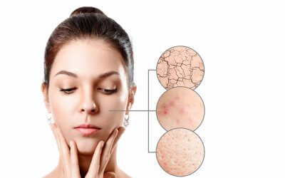 Peau qui tiraille : 5 solutions efficaces